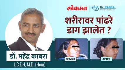 शरीरावर पांढरे डाग झालेत? | How to Get Rid of White Patches on Skin | Dr. Mahendra Kabra - Marathi News | | Latest sakhi News at Lokmat.com