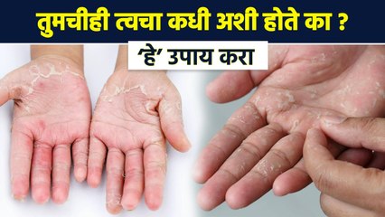 त्वचा का निघते? | How to Get Rid of Skin Peeling | Skin Peeling Treatment at Home | Lokmat Sakhi RI3 - Marathi News | | Latest sakhi News at Lokmat.com