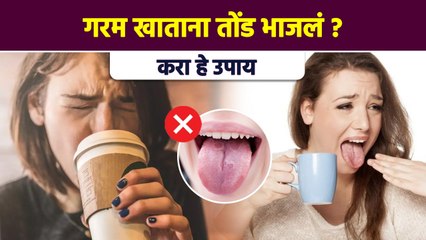 गरम खाताना तोंड भाजलं तर | How to Treat a Burn on the Roof of Your Mouth | Lokmat Sakhi | AI2 - Marathi News | | Latest sakhi News at Lokmat.com