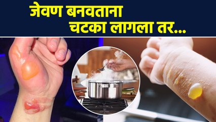 जेवण बनवताना भाजल्यावर काय कराल? | How To Treat Burns At Home | Home Remedies for Burns | AI2 - Marathi News | | Latest sakhi News at Lokmat.com