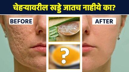 चेहऱ्यावरील खड्डे नेमके घालवायचे कसे? | How to Get Rid of Acne Scars | Acne Scars Treatment | AI2 - Marathi News | | Latest sakhi News at Lokmat.com