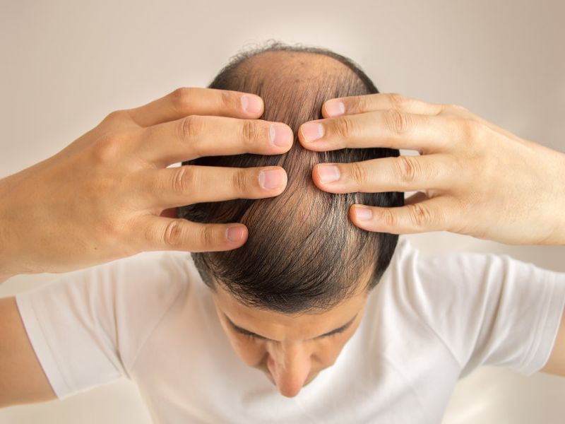 ही' आहेत केसगळतीची मुख्य कारणं; जाणून घ्या त्यावरील उपाय - Marathi News | These are the causes and solutions for hair loss or hair fall | Latest beauty News at Lokmat.com