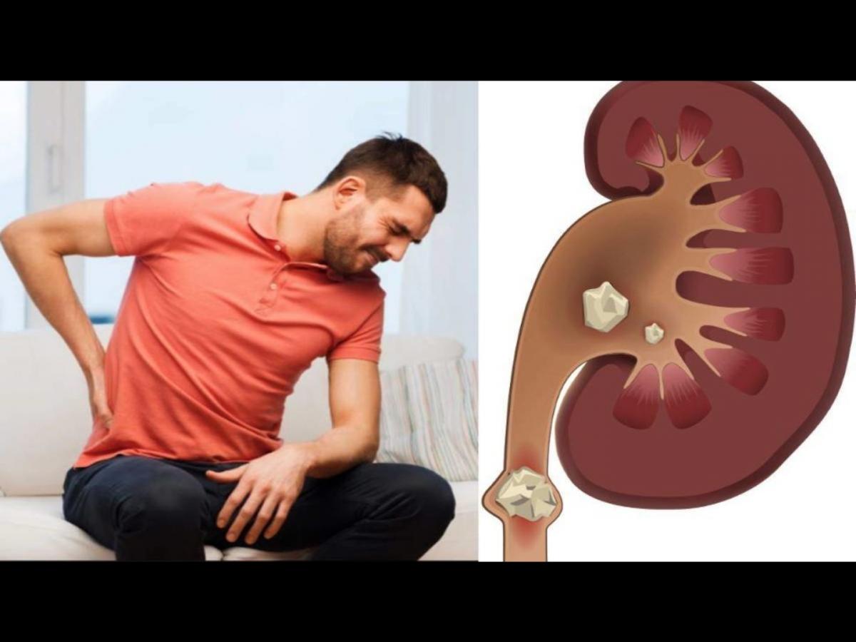 Men Stone Problem तुमची ही सवय ठरू शकते किडनी स्टोनचं कारण, वेळीच व्हा सावध! - Marathi ...