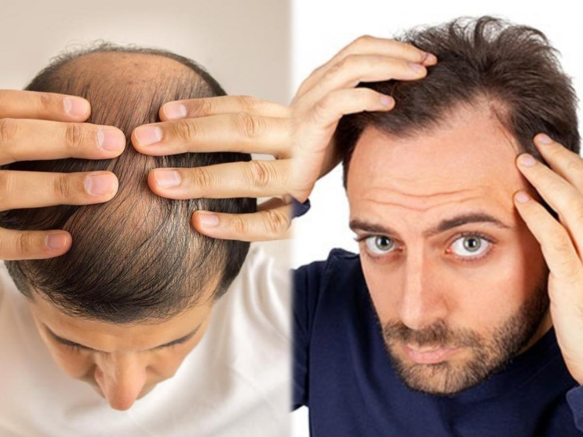 Hair Loss 