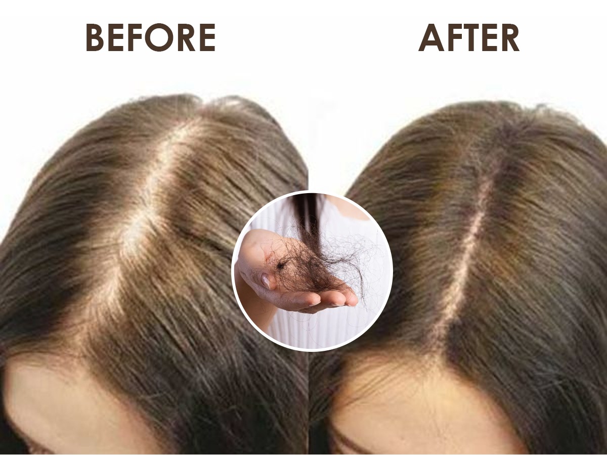 केस गळूनगळून खूप पातळविरळ झाले? डॉक्टर सांगतात, ५ सोपे उपाय, केस