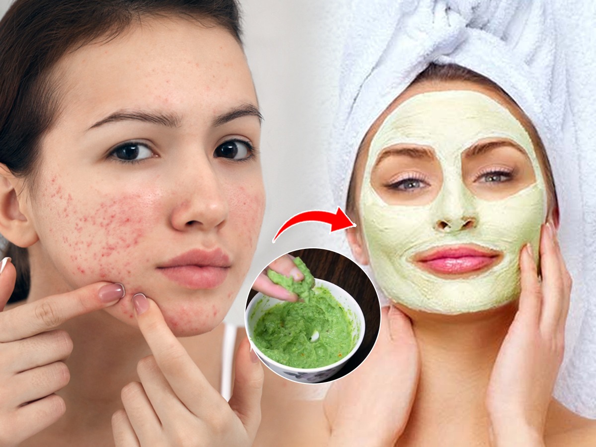 चेहऱ्यावर सतत पिंपल्स, मोठे फोड येतात? १ सोपा उपाय, पिंपल्स होतील गायब