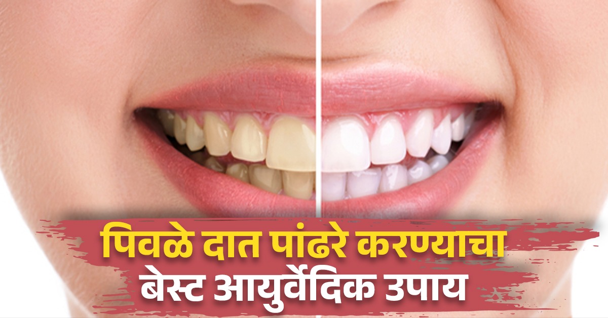 दात पांढरे करण्यासाठी डॉक्टरांना द्यावे लागणार नाही पैसे, घरीच तयार करा