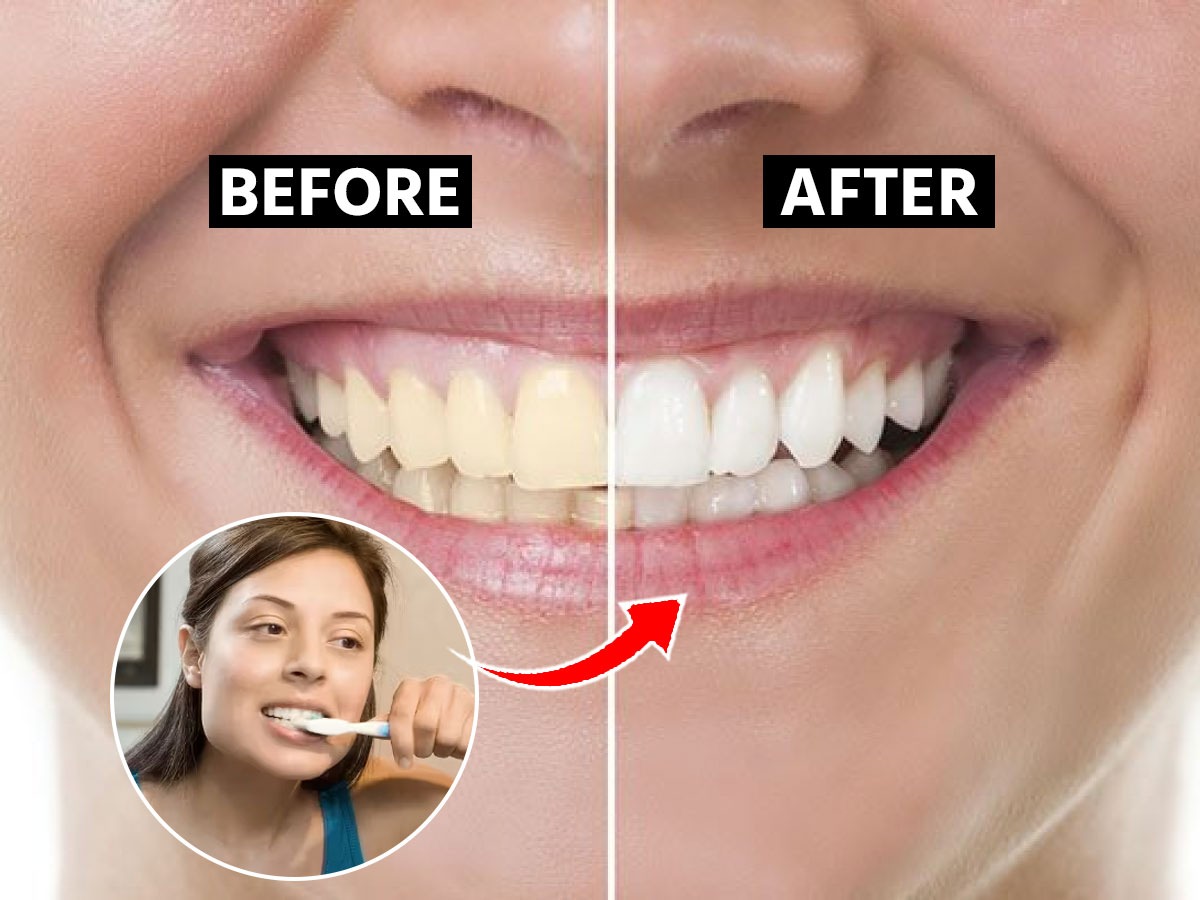 पिवळे झालेले दात पांढरेशुभ्र करायचे तर नियमित वापरा ४ गोष्टी; दात