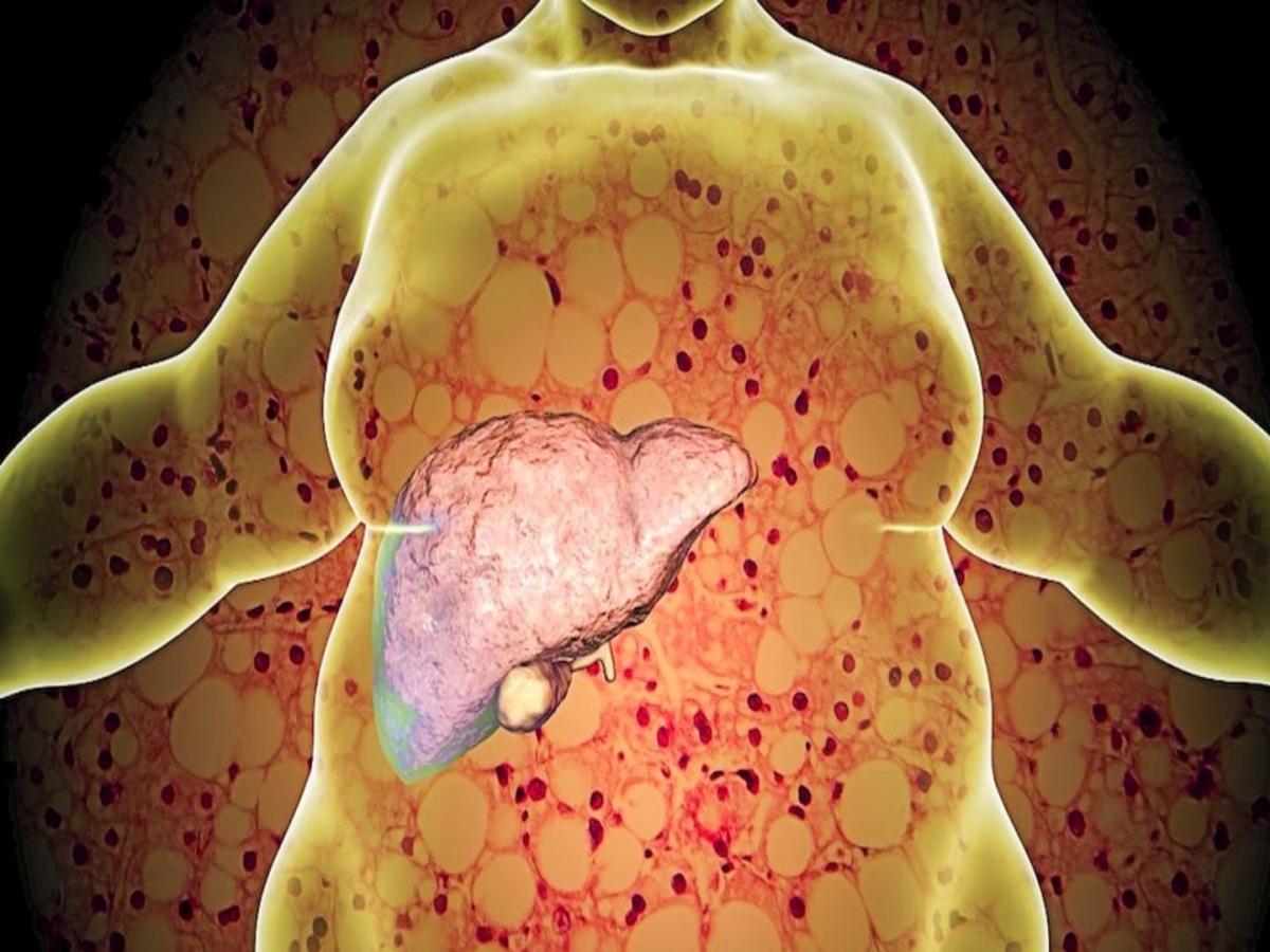 fatty-liver-disease