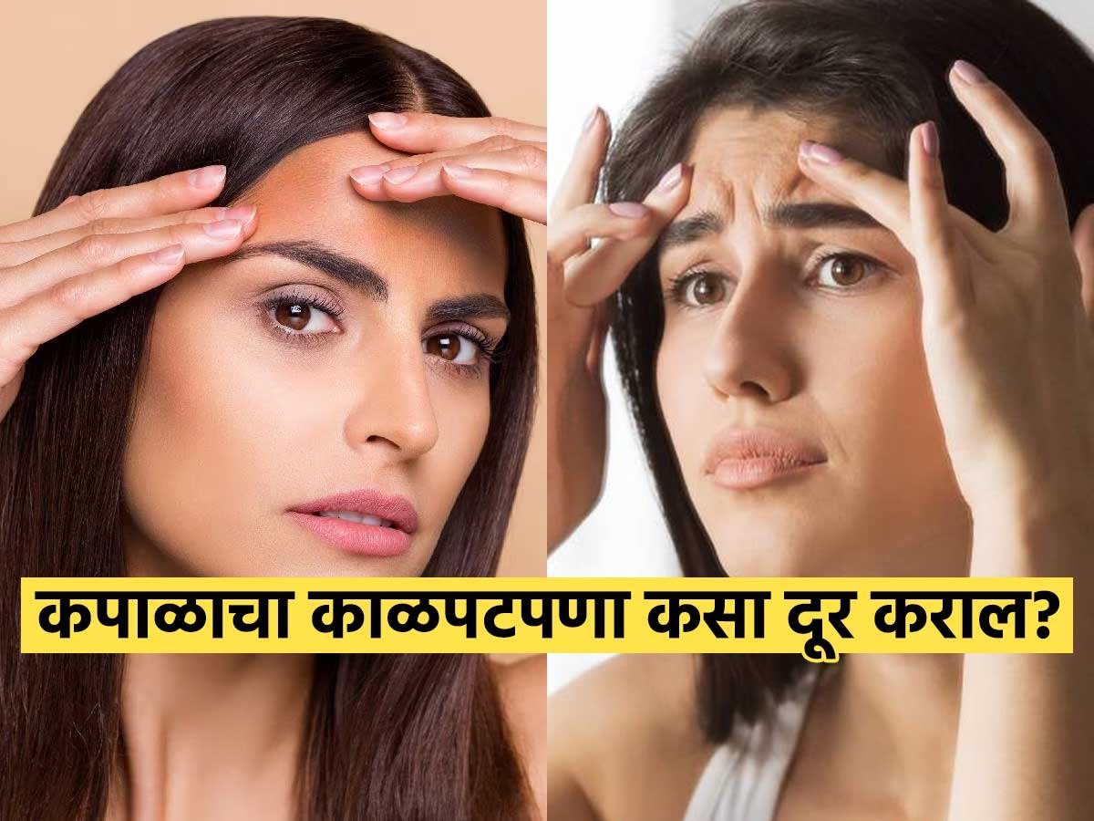 कपाळावरचा काळपटपणा ५ मिनिटांत कमी करणारा नॅचरल उपाय, ना महागडे क्रिम ना ...