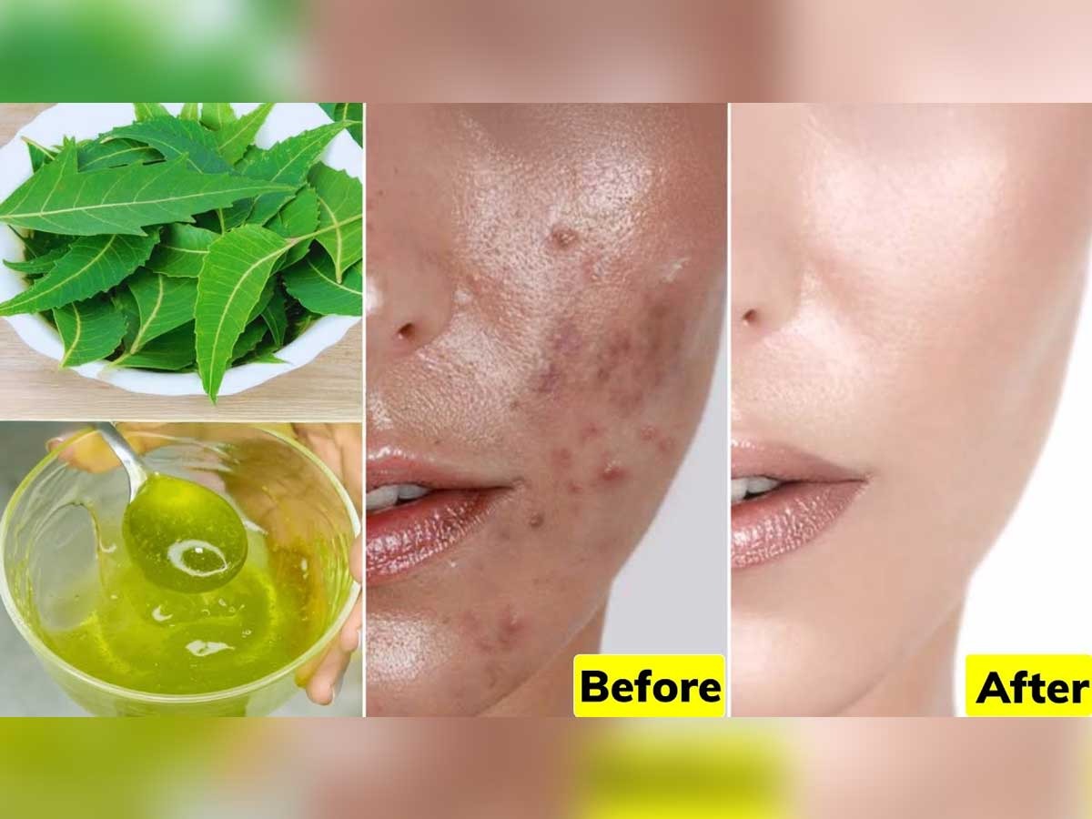 Seborrheic Dermatitis: Symptoms, Causes & Treatment - Cleveland Clinic