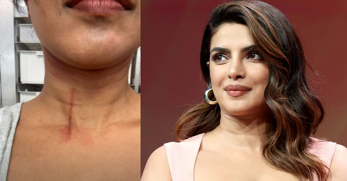 थोडक्यात वाचली प्रियंका चोप्रा, मानेवर मोठी जखम, 'देसी गर्ल'ची अशी(02)