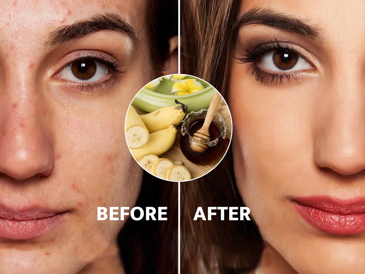 तेलकट त्वचेच्या समस्याच फार.. करा मधाच्या 3 फेसपॅकचा सोपा उपाय