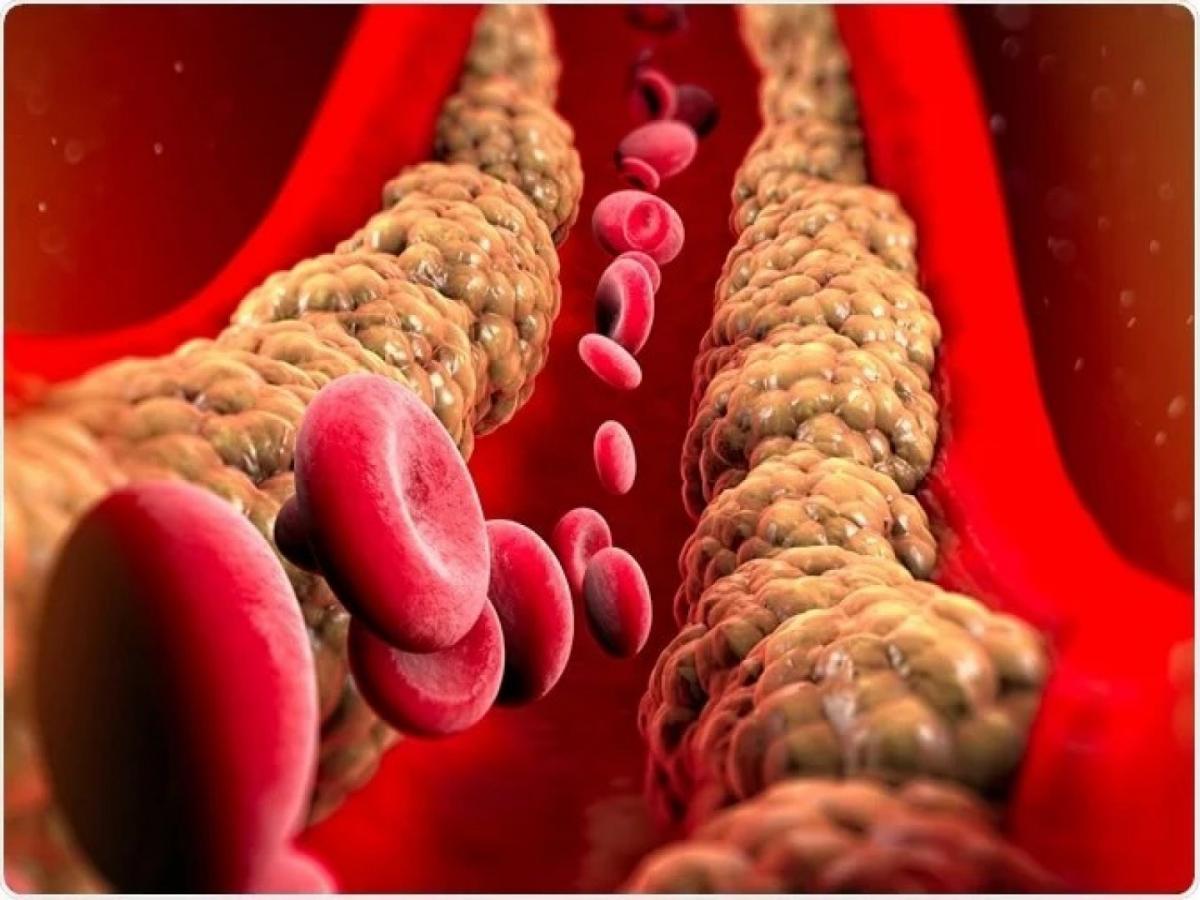 cholesterol-triglycerides