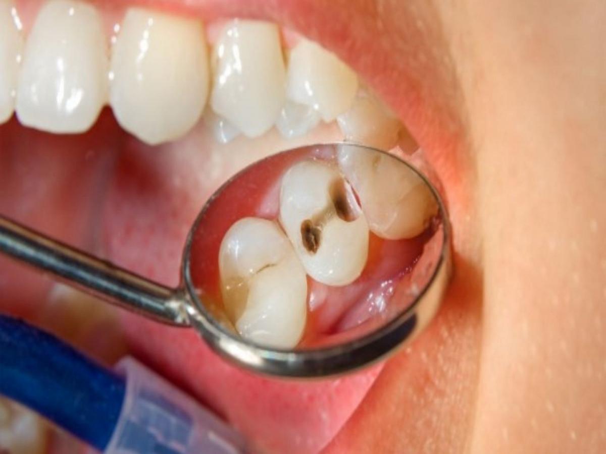 Teeth Cavity दातांना लागलेल्या किडीमुळे आहात हैराण, हे घरगुती उपाय