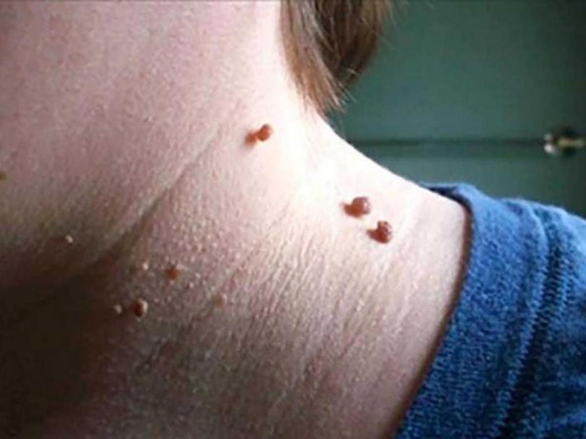 चामखिळीने लूक बिघडवलाय?; 'या' 4 टिप्सनी करा दूर - Marathi News | Get rid of  warts these 4 easy tips wart removal home remedies treatment | Latest  beauty News at Lokmat.com