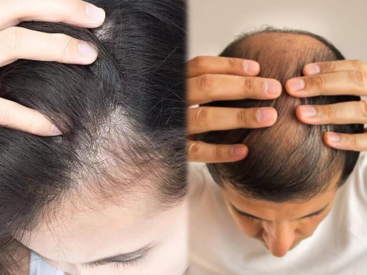 Hair Loss Mistakes in marathi य 4 भयनक करणमळ २० वय वरषच पडल  टककल समसय मळपसन उपटन टक  4 mistakes that causes hair loss and  baldness in marathi  Maharashtra Times