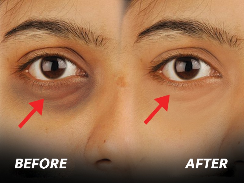 How To Remove Dark Circles डार्क सर्कल्समुळे चेहरा ग्लोईंग दिसत