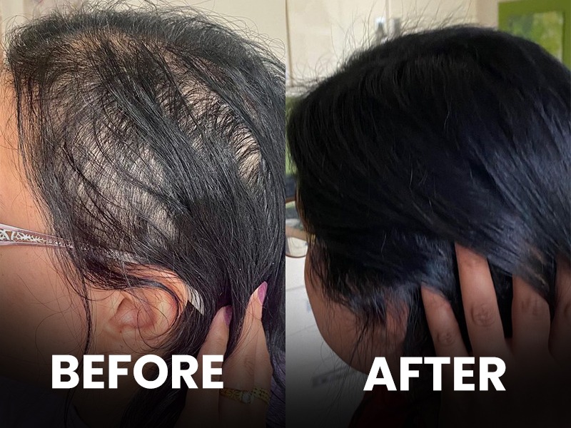 कय आहत लहन वयत कसगळत हणयच करण जणन घय उपय  Marathi News   What are the causes of hair loss you should know this  Latest health News  at Lokmatcom