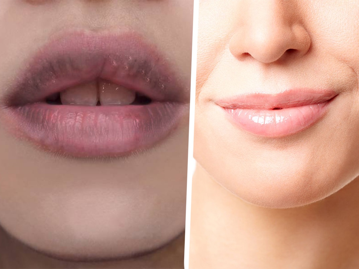 ओठ काळे पडलेत त्याला कारण तुमच्या ६ सवयी; २ घरगुती उपाय, ओठ होतील