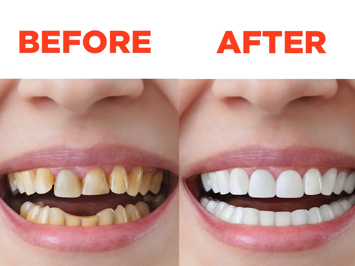 How to Whiten Yellow Teeth रोज स्वच्छ घासले तरी दात पिवळेच दिसतात