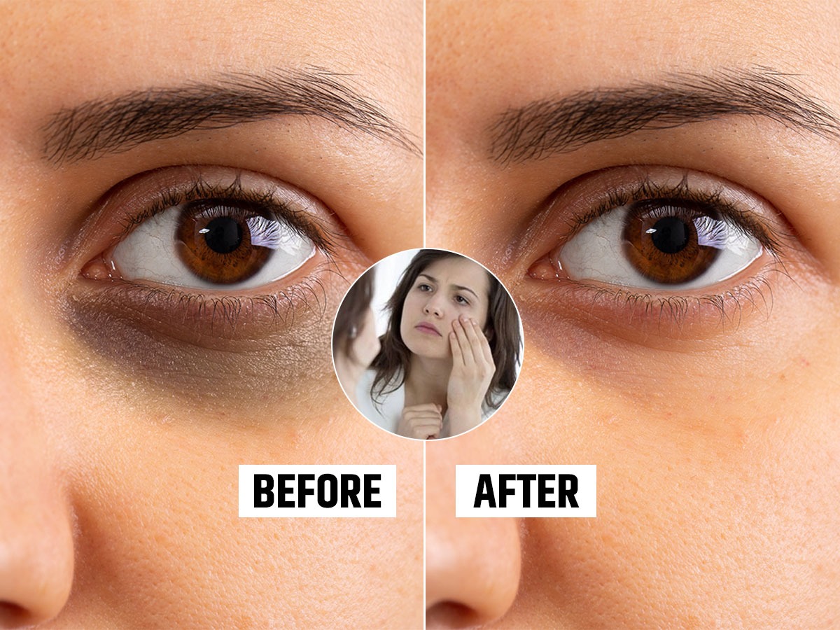 Dark Circles Home Remedy डार्क सर्कल्समुळे चेहरा खूपच खराब दिसतोय? 6