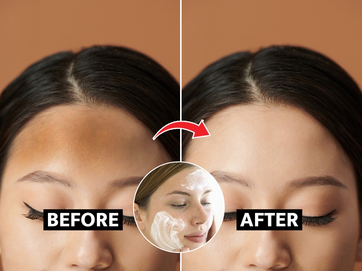 फक्त कपाळ खूप काळे पडले आहे? ५ घरगुती उपाय काळेपणा होईल कमी Marathi