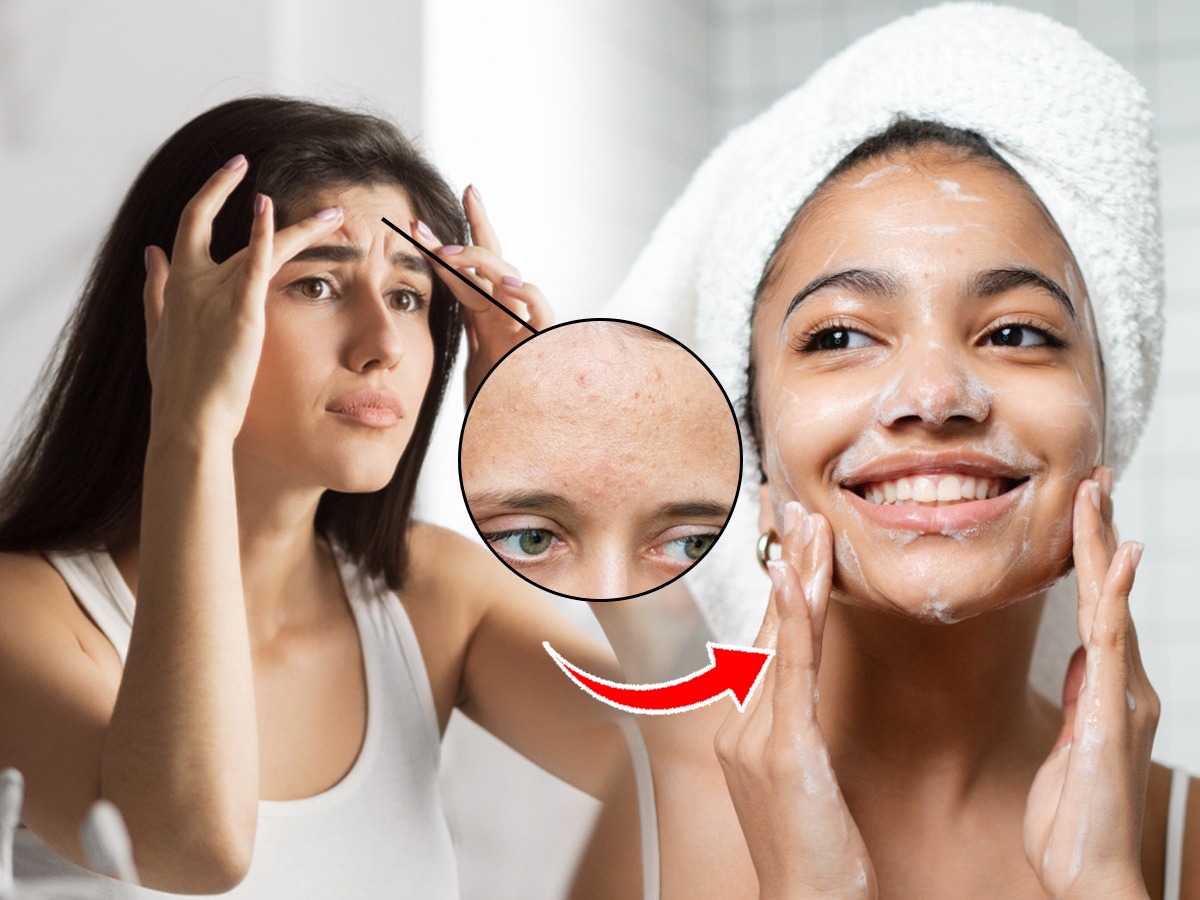 कपाळावर फार पिंपल्स, चेहरा विचित्र दिसतो? १ उपाय, पिंपल्स होतील कमी