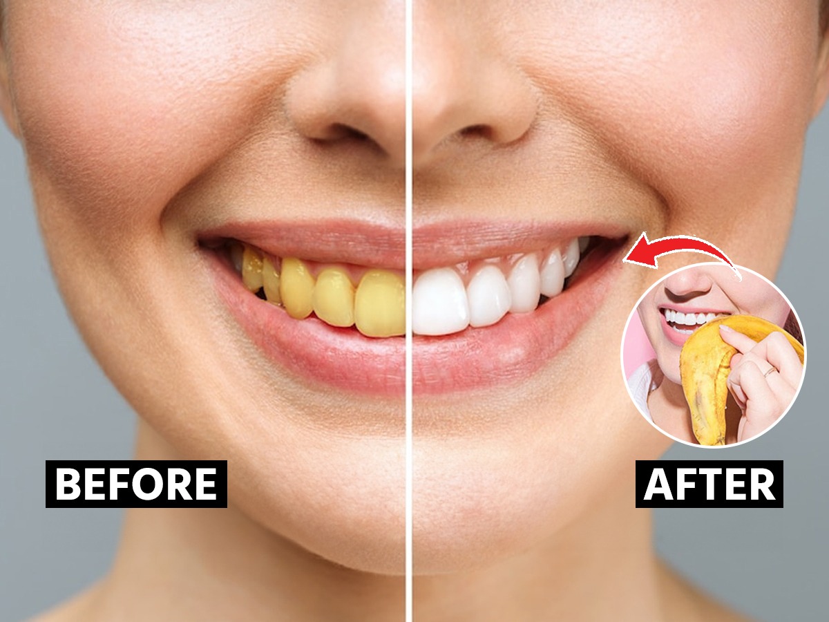 पिवळट दात पांढरेशुभ्र होऊन मोत्यासारखे लख्ख चमकतील बघा केळीच्या