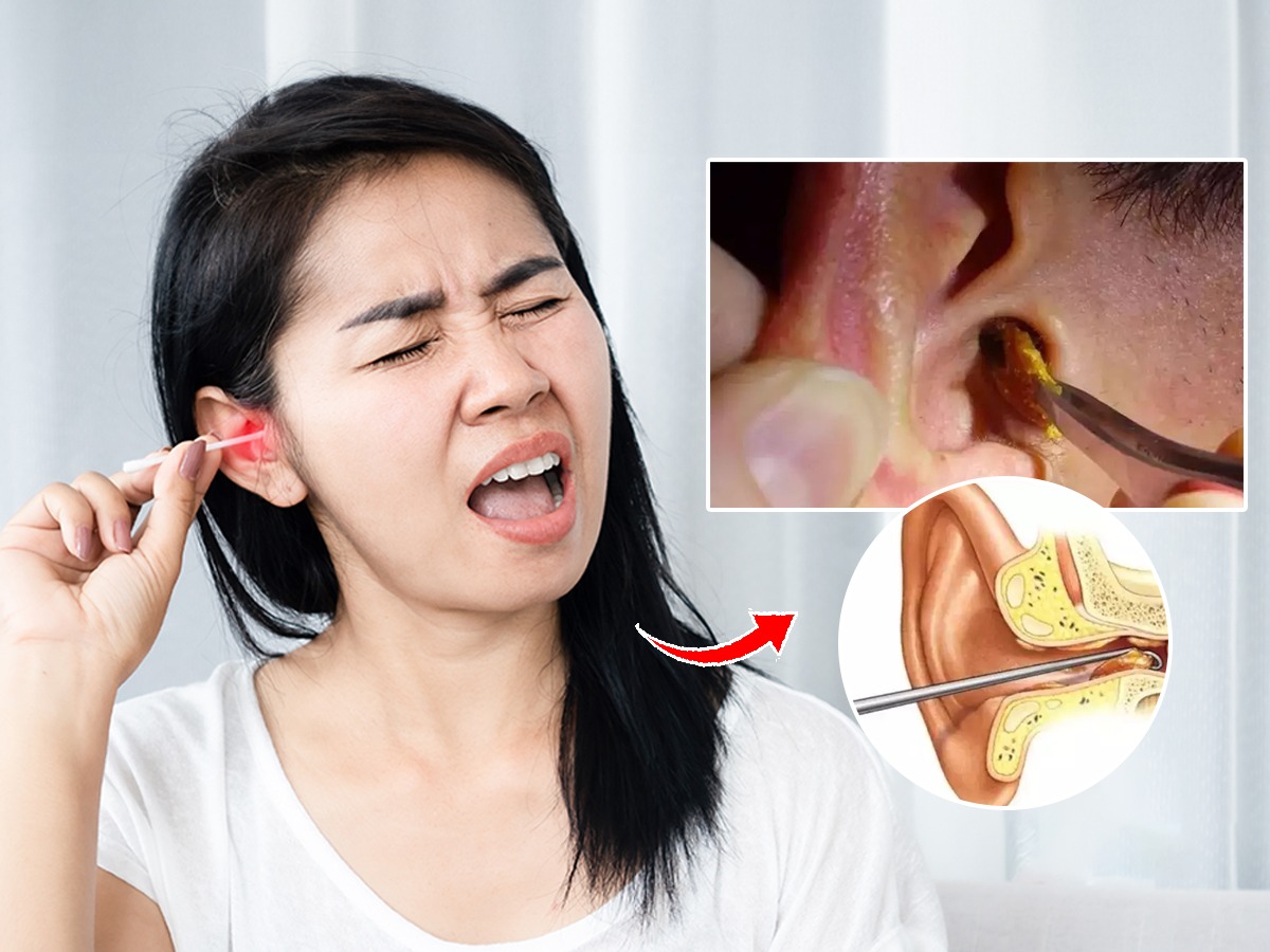 कानात मळ झाला आहे? पिनइअरबड्स घालू नका, पाहा ३ उपाय बहिरेपणाचा धोका