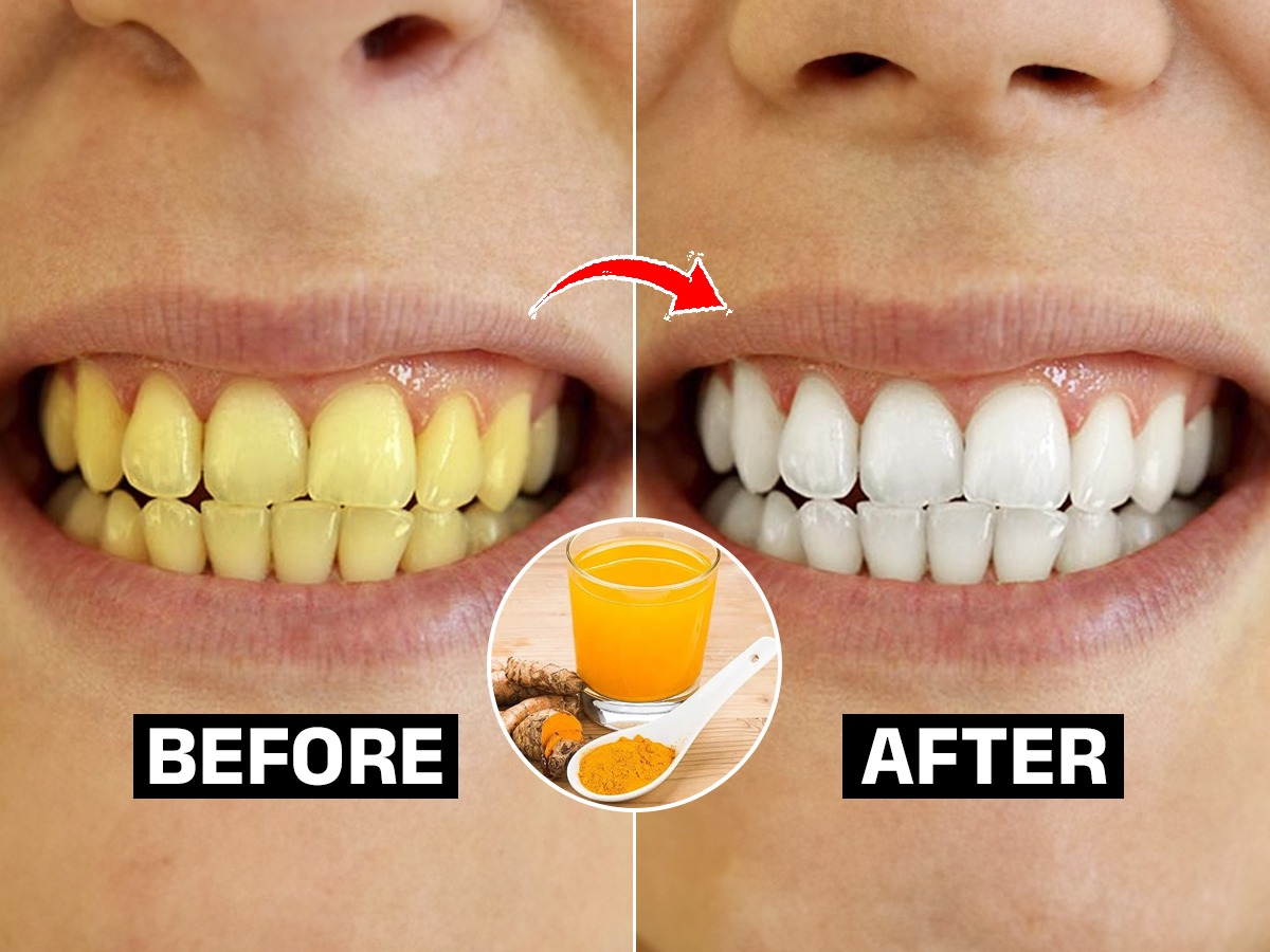 दातांवर पिवळाचिकट थर दिसतो? अमेरीकन डेंटिस्ट सांगतात ५ गोष्टी करा