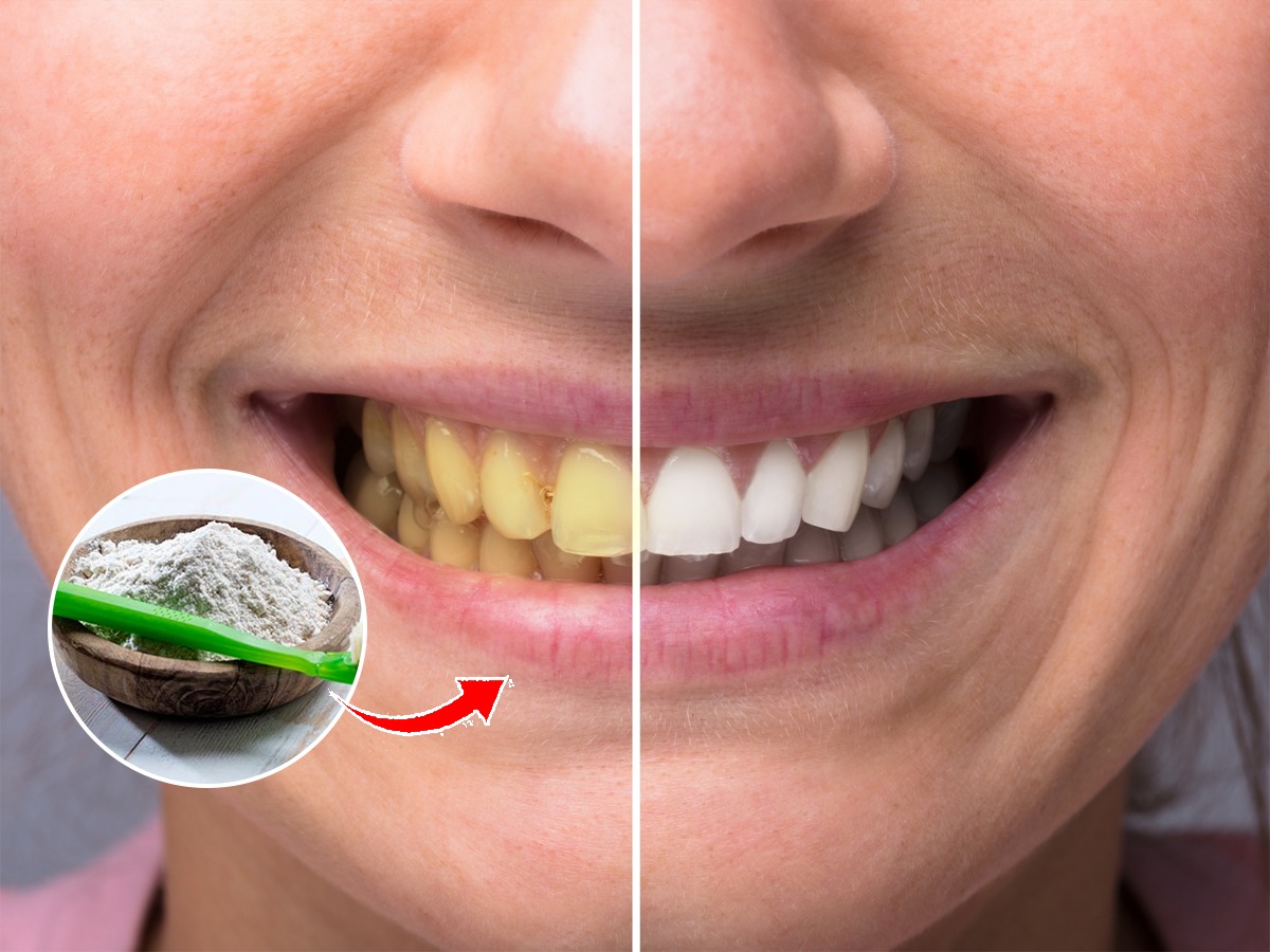 दात पिवळटहिरड्या काळ्या झाल्या? 'या' घरगुती पावडरनं दात घासा
