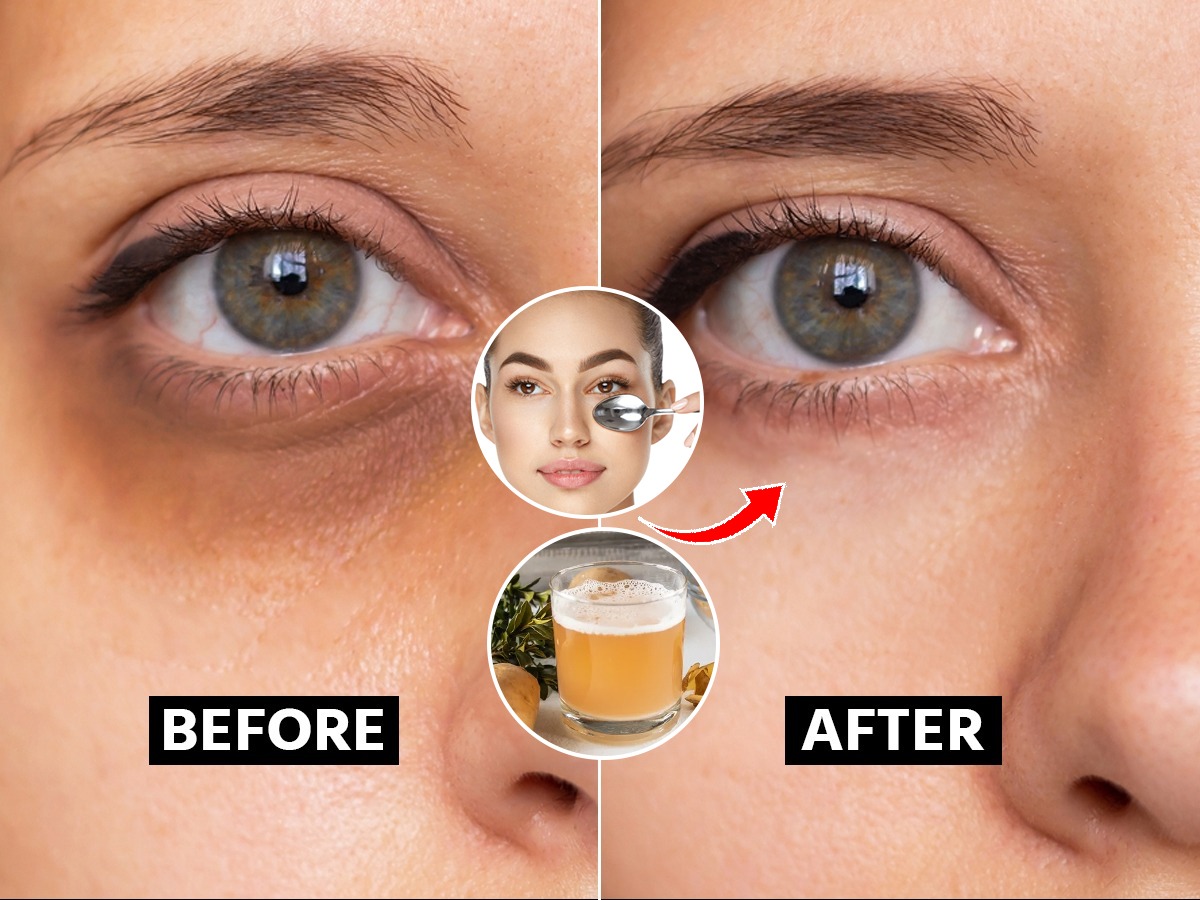 Eye Puff Injection डार्क सर्कल्स, डोळ्यांखालच्या सुरकुत्यांमुळे कमी वयातच वयस्कर दिसता? ४ ...