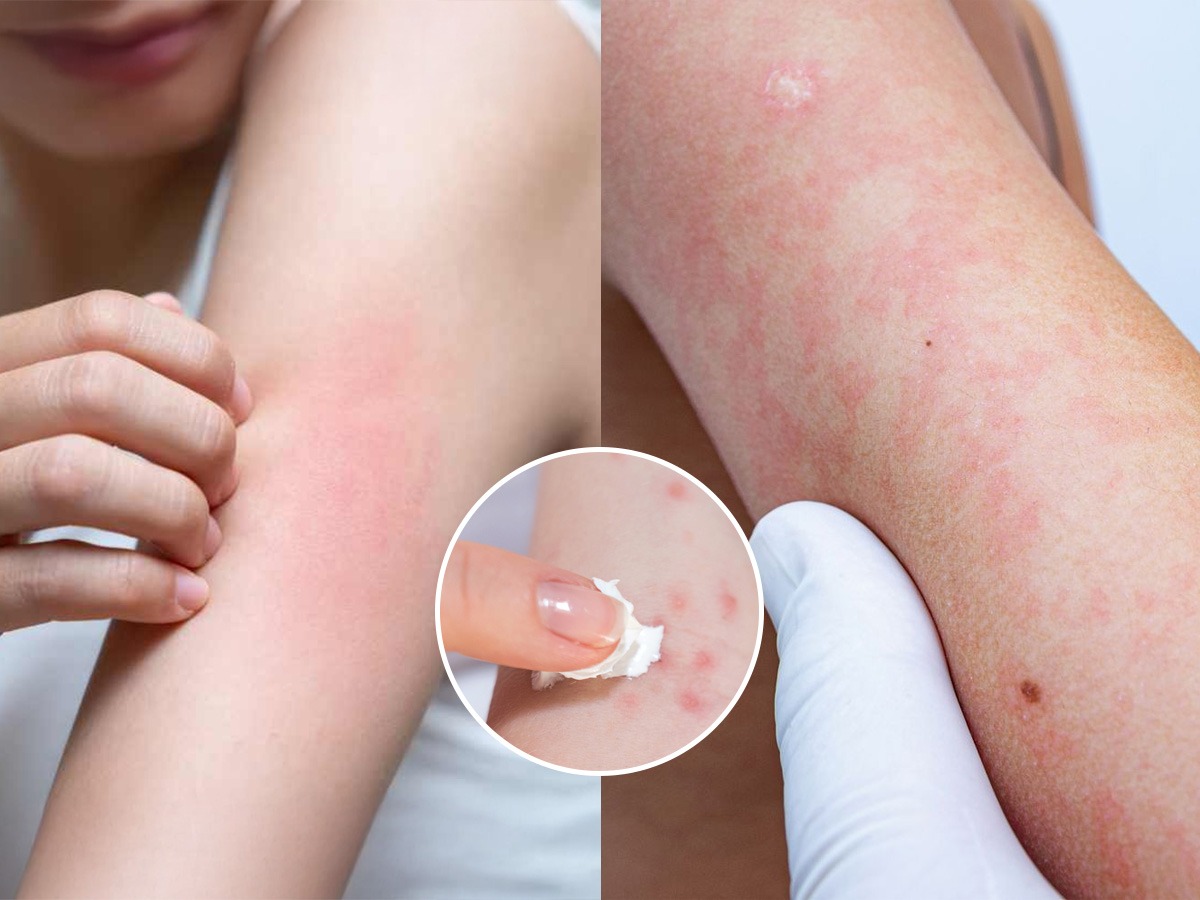 एकदा दंडावर हात फिरवून पाहा, पुरळ लागते का? न दिसणारी लहान पुरळ-बारीक ...