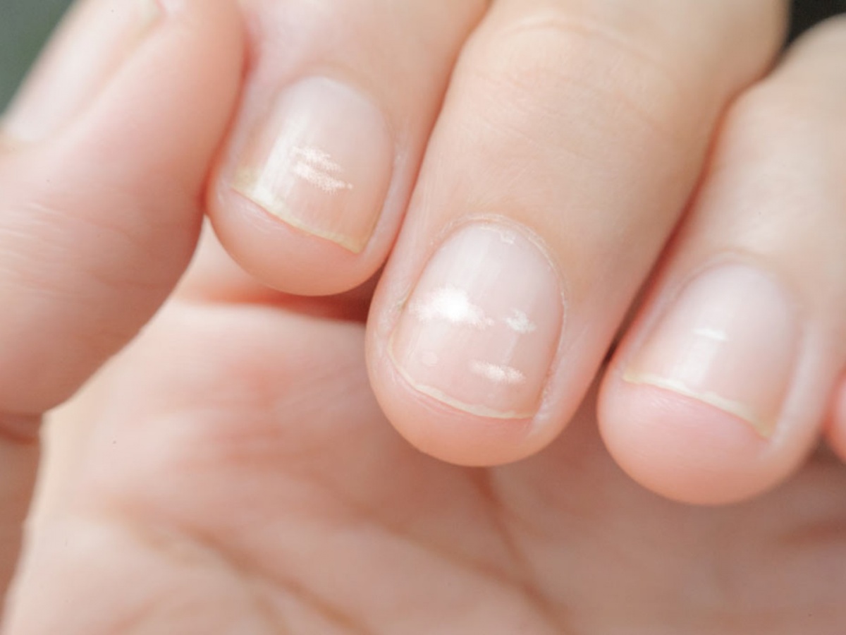 I'm 22 but I've always had horizontal nail ridges (Beau's lines) what are  their causes? - Quora