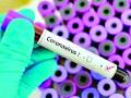 कोरोना रूग्णांचे शतक पार - Marathi News | Over a century of corona patients | Latest gadchiroli News at Lokmat.com