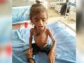 चार महिन्यात कुपोषित बालकांची संख्या चार पटीने - Marathi News | Four times the number of malnourished children in four months | Latest nandurbar News at Lokmat.com