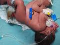 जिल्हा रुग्णालयात जन्मले सयामी जुळे ! - Marathi News | Siamese twins born in district hospital! | Latest nashik News at Lokmat.com