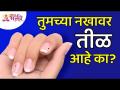 तुमच्या नखावर तीळ असेल तर तुम्ही काय करावे? What to do if you have moles on your nails?Lokmat Bhakti - Marathi News | What to do if you have moles on your nails? What to do if you have moles on your nails? Lokmat Bhakti | Latest bhakti Videos at Lokmat.com