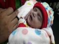 15 तासांच्या बाळावर यशस्वी शस्त्रक्रिया - Marathi News | Successful cardiac Surgery on a 15 hour born baby | Latest navi-mumbai News at Lokmat.com