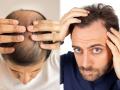 Hair Loss : How to prevent hair loss in teenage males - Hindi News | Hair Loss : How to prevent hair loss in teenage males | Latest health Photos at Lokmattimes.com