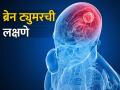 ब्रेन ट्युमरची सुरुवातीची लक्षणे, दिसताच डॉक्टरांना दाखवले पाहिजे - Marathi News | Early symptoms of brain tumor, for go to the doctor immediately | Latest health News at Lokmat.com