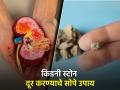 मोठ्यातला मोठा किडनी स्टोन बाहेर काढण्याचे सोपे उपाय, लगेच मिळेल आराम! - Marathi News | Effective methods to dissolve kidney stone without medicine or operation | Latest health News at Lokmat.com