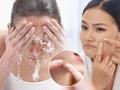 How To Get Rid from Pimples : पिंपल्स, डागांमुळे चेहरा फार खराब झालाय? स्वयंपाकघरातील १ गोष्ट, पिंपल्सला करा बाय - Marathi News | How To Get Rid from Pimples: Pimples, spots on the face is very bad? 1 thing in the kitchen, bye to pimples | Latest sakhi News at Lokmat.com