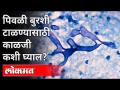 काळ्या, पांढऱ्या बुरशीनंतर भारतात पिवळी बुरशी Yellow fungus | Mucormycosis | Maharashtra News - Marathi News | Yellow fungus in India after black and white fungus Mucormycosis | Maharashtra News | Latest maharashtra Videos at Lokmat.com