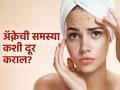 खराब गट हेल्थमुळे त्वचेवर येते पुरळ, डॉक्टरांनी सांगितलं काय खाऊन दूर होईल 'ही' समस्या! - Marathi News | How bad gut health can cause acne skin doctor tells tips | Latest sakhi News at Lokmat.com