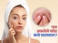 पू भरलेले-ठणकणारे चेहऱ्यावरचे जाडजूड फोड फोडू नका, करा ३ उपाय-फोड आणि डाग गायब - Marathi News | How to treat acne at home with home remedies | Latest sakhi News at Lokmat.com