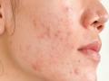 पिंपल्स आणि डागांपासून होईल सुटका; फक्त करा 'हे' घरगुती उपाय - Marathi News | Beauty Tips Home remedies for pimples and acne | Latest beauty Photos at Lokmat.com
