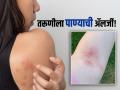अजबच! 'या' तरुणीला पाण्यासह ४० गोष्टींची ॲलर्जी, पाण्याची ॲलर्जी असेल तर जगते कशी.. - Marathi News | Girl with water allergy aquagenic urticaria rare disease | Latest sakhi News at Lokmat.com