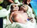 दोन डोक्यांचे बाळ २४ तासांतच दगावले, बीडमधील घटना - Marathi News | The two-headed baby died in 24 hours, the incident in Beed | Latest beed News at Lokmat.com